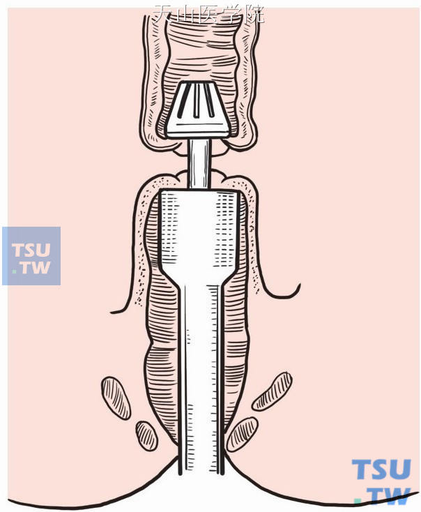 乙状结肠直肠端端吻合（管状吻合器双吻合器法）