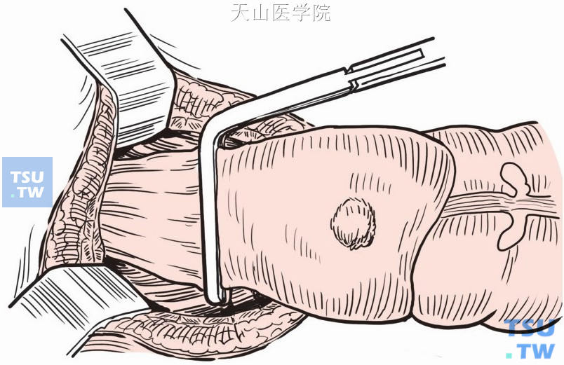 直肠经腹切除结肠造口术（Hartmann术）