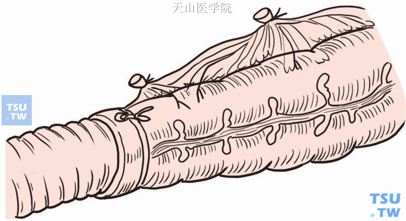 螺纹管连同结肠一起经肛门拉出