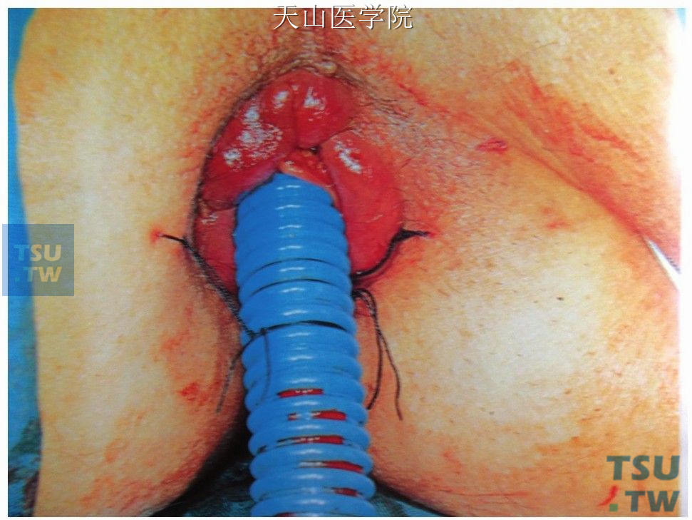 螺纹管缝扎固定在肛门两侧皮肤上
