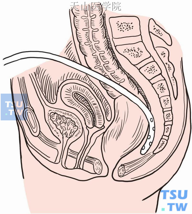 骶前置引流管经腹部切口下端引出