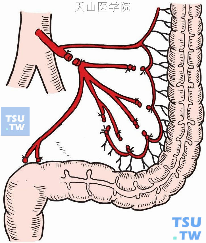 结扎离断乙状结肠边缘血管，注意保护降结肠、乙状结肠血管弓