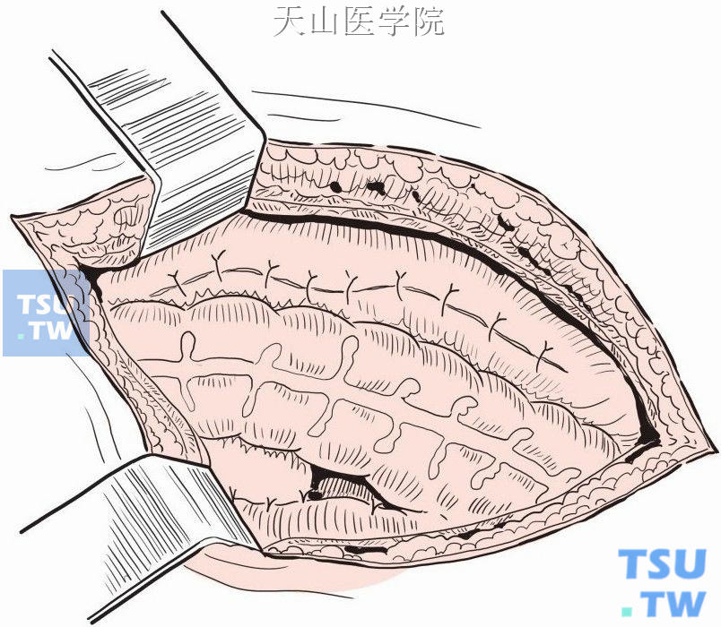 结肠系膜缘与后腹膜缝合