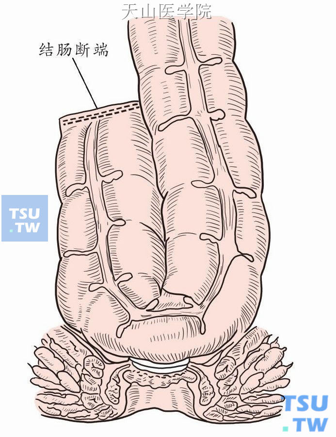 结肠“J”形袋肛管吻合术