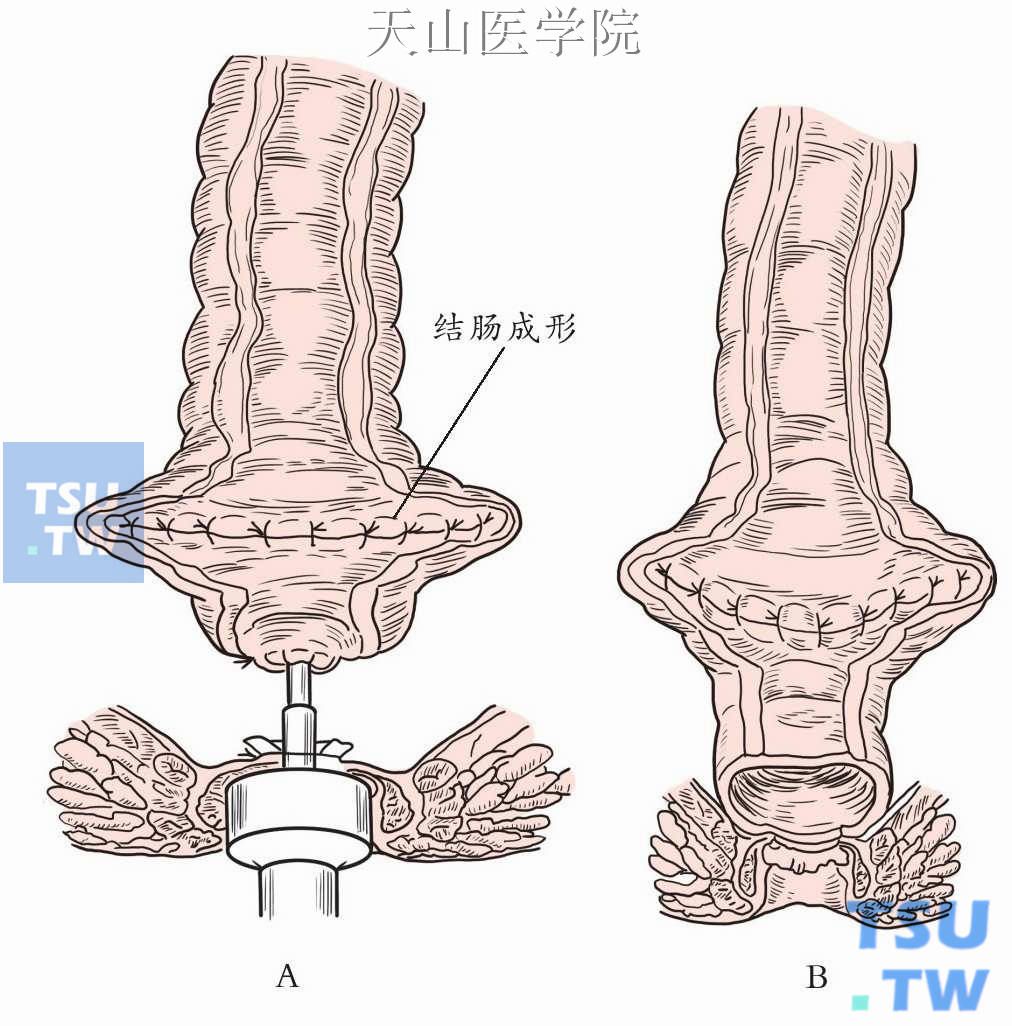 直肠超低位前切除结肠肛管吻合术（Parks术）