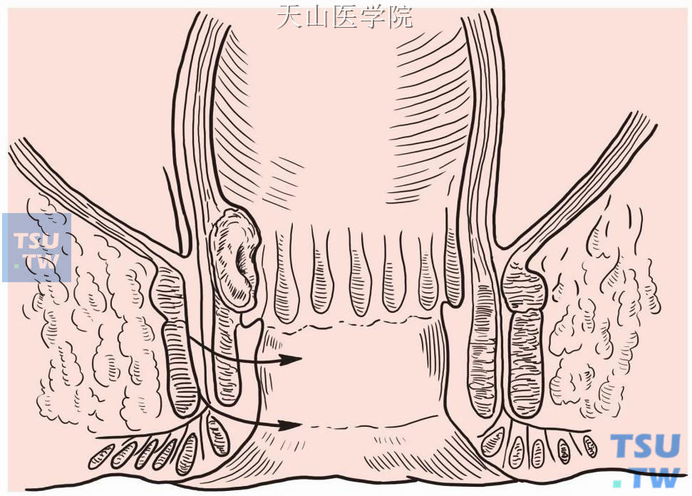 括约肌间直肠切除术