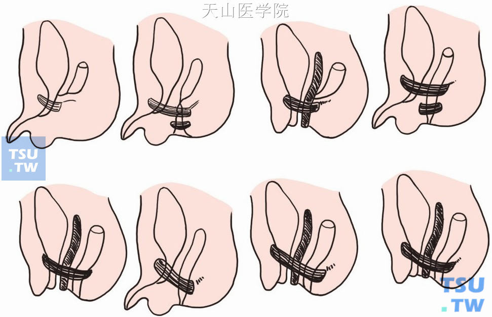 阴部畸形的类型