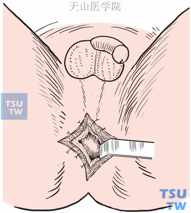 肛门膜状闭锁部位做“十”字形切开，行皮肤与粘膜间断缝合