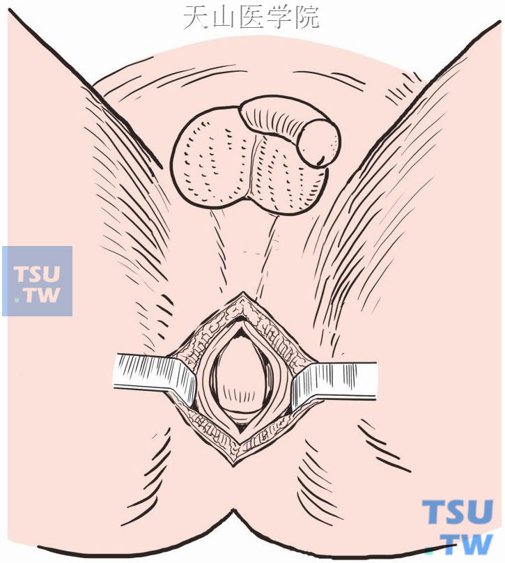 会阴部做“十”字形切口，分离见直肠盲端