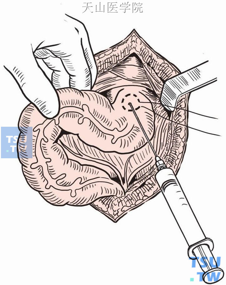 经乙状结肠结肠带穿刺引流粪汁和气体