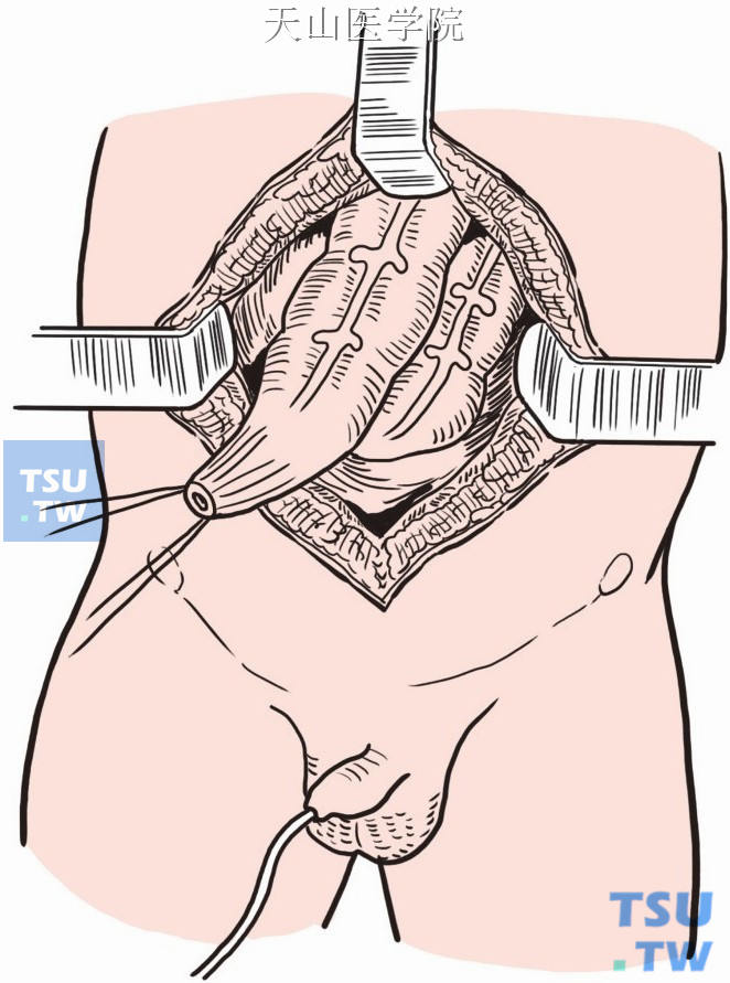 游离直肠并离断