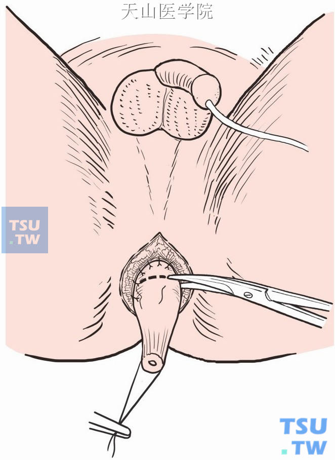 直肠浆肌层与皮下组织间断缝合数针，切除多余的直肠部分