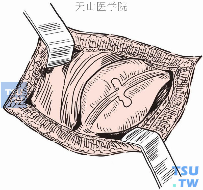 找到直肠盲端