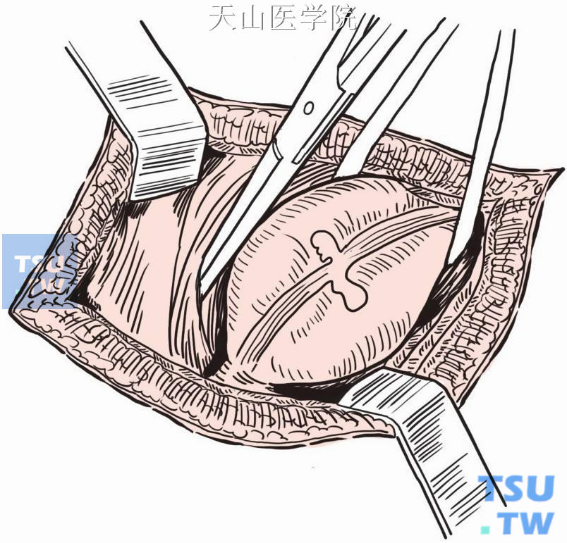 先天性肛门直肠畸形矫治术（肛门闭锁）