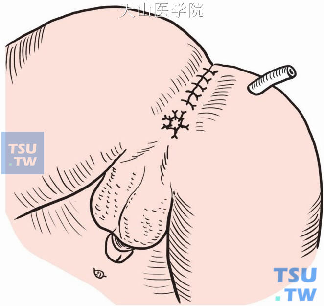 经骶部切口将直肠与周围组织做数针缝合固定。缝合原切口