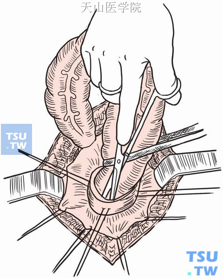 切开浆肌层并向直肠盲端剥离粘膜层