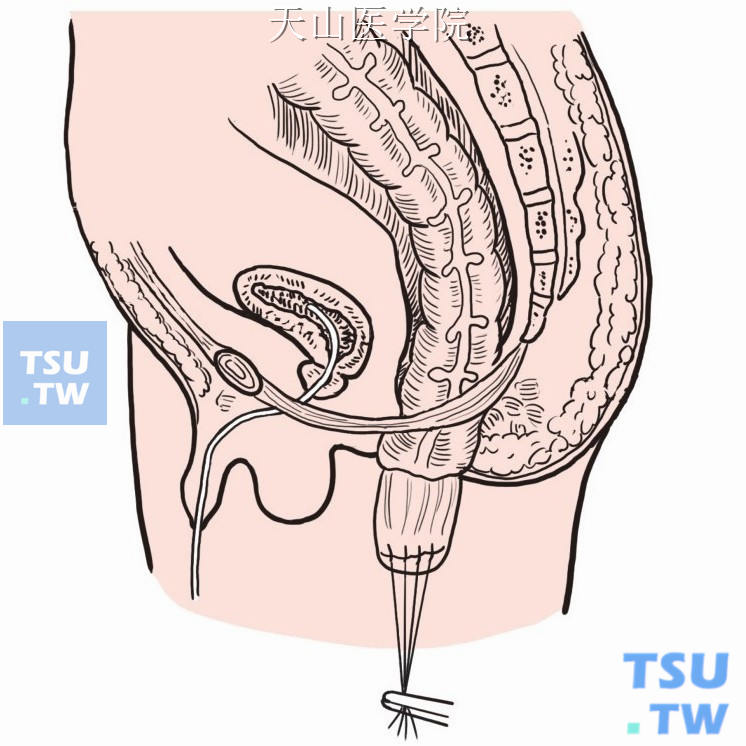 经隧道将近端结肠由直肠肌鞘内拉出肛门
