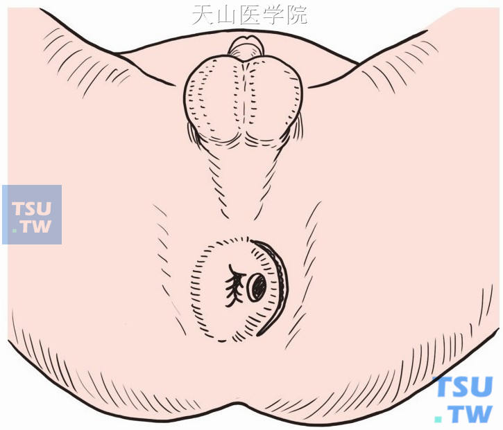瘢痕外侧做肛周半环形切口
