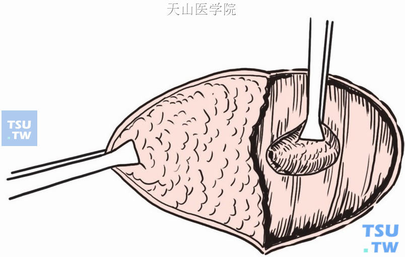 游离括约肌断端