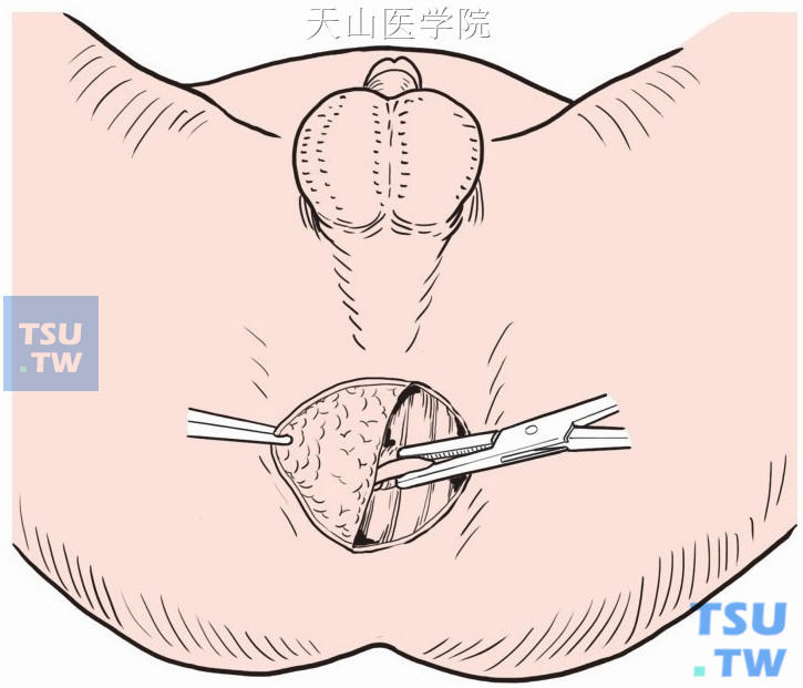 分离显露内括约肌的断端