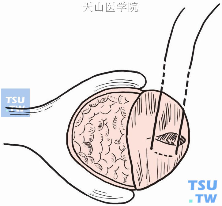 钢丝穿过一侧断端，两端由切口对侧皮肤穿出