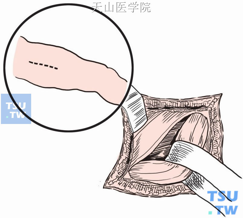 钝性游离股薄肌上段，与其他肌肉分离
