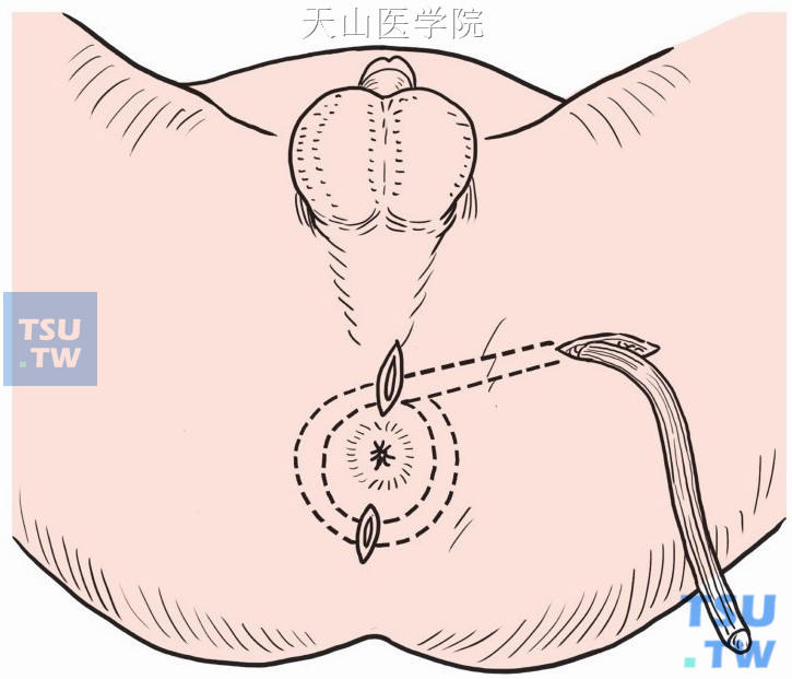 肛周及肛门前方与股上部切口间分别分离形成隧道