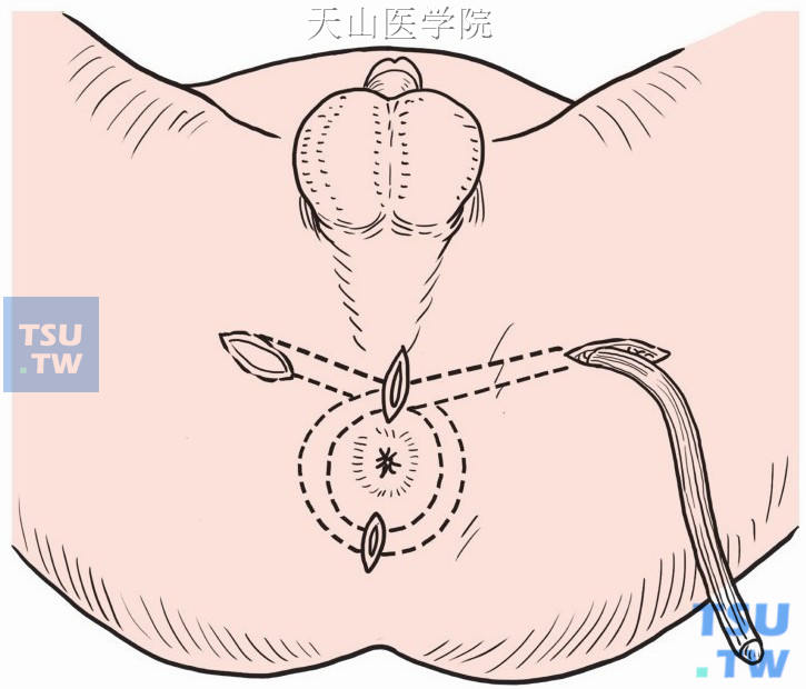 对侧耻骨结节向肛门前方切口做一隧道