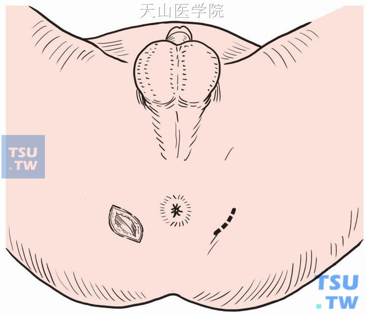 两侧坐骨结节之间弧形切口，切开显露臀大肌内侧