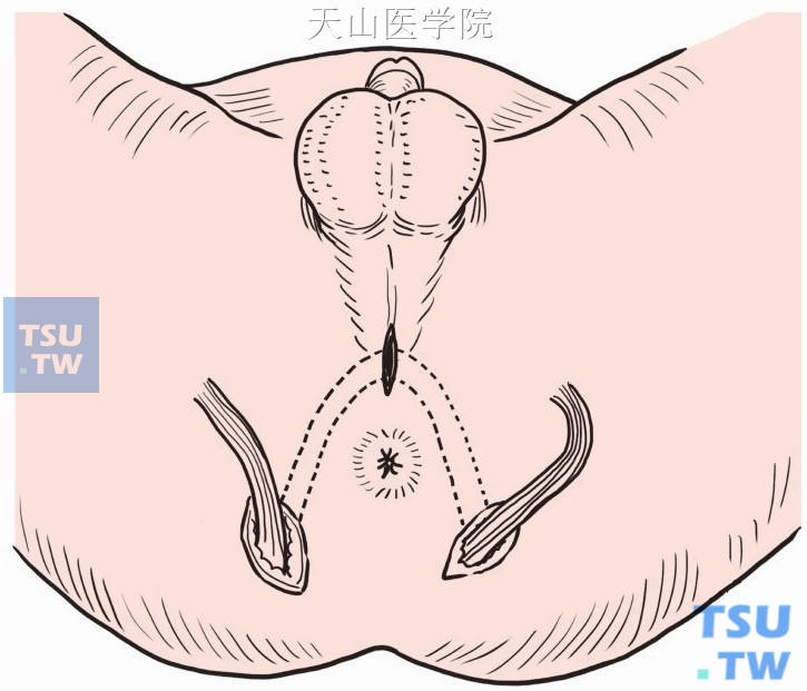 肛门前方中线切口，围绕肛管分离与肛管后方切口贯通形成隧道