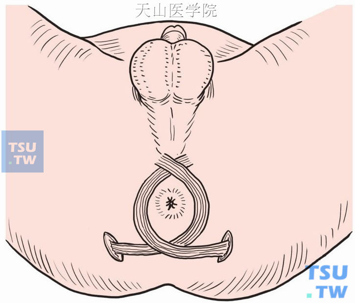 两侧臀大肌肌片在肛管后方交叉穿过肛管侧方隧道引出