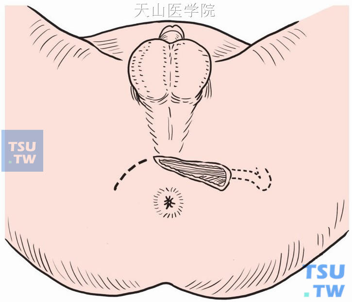 肛门前方两侧坐骨结节间做弧形切口，切开显露两侧会阴浅横肌