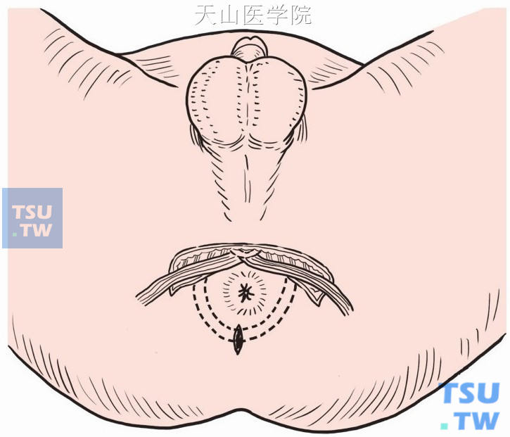 肛门后方中线做放射状切口，沿肛管两侧向前方分离贯通形成隧道