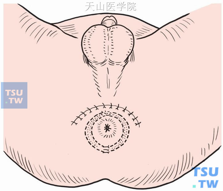 两侧会阴浅横肌肌片褥式缝合