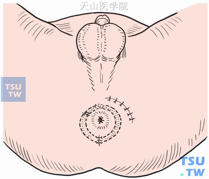 一侧会阴浅横肌离断，围绕肛管后方与括约肌断端缝合  手术意外的处理