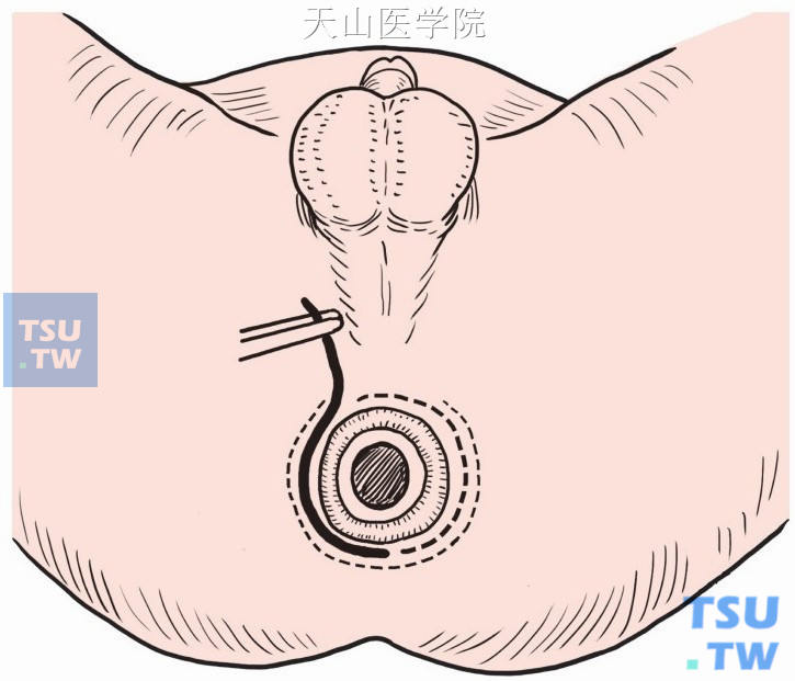 形切口，分离解剖显露肛门内括约肌