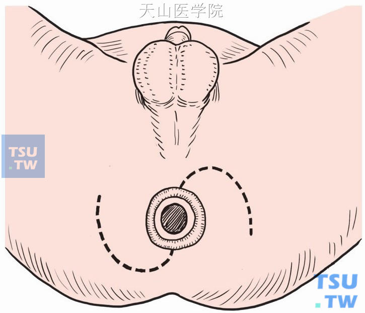 以肛门为中心做“S”形切口，肛门两侧做两个皮片