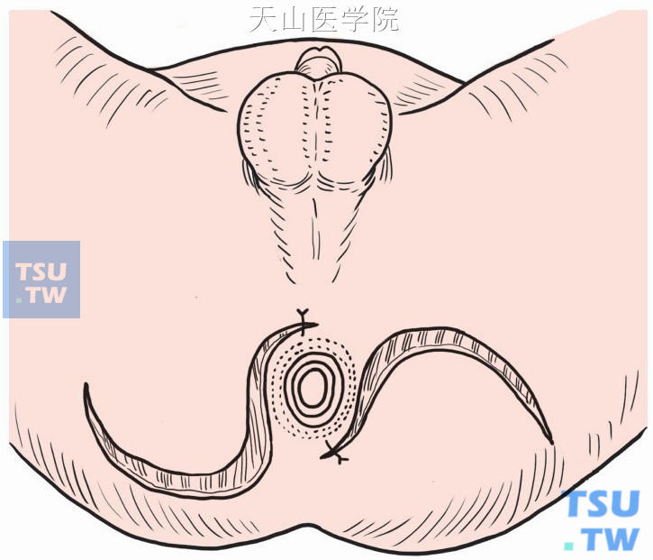 皮片肛管成形术