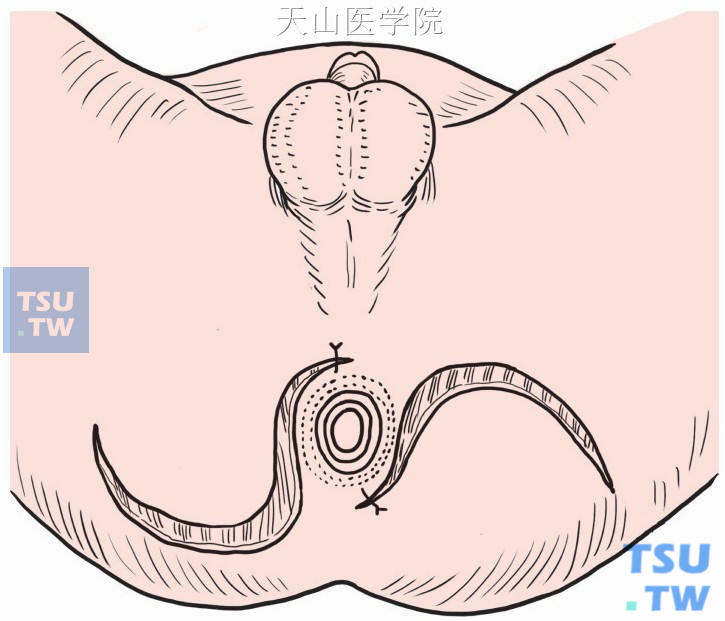 将两侧皮片顶部牵向肛管前后方，与直肠粘膜缝合