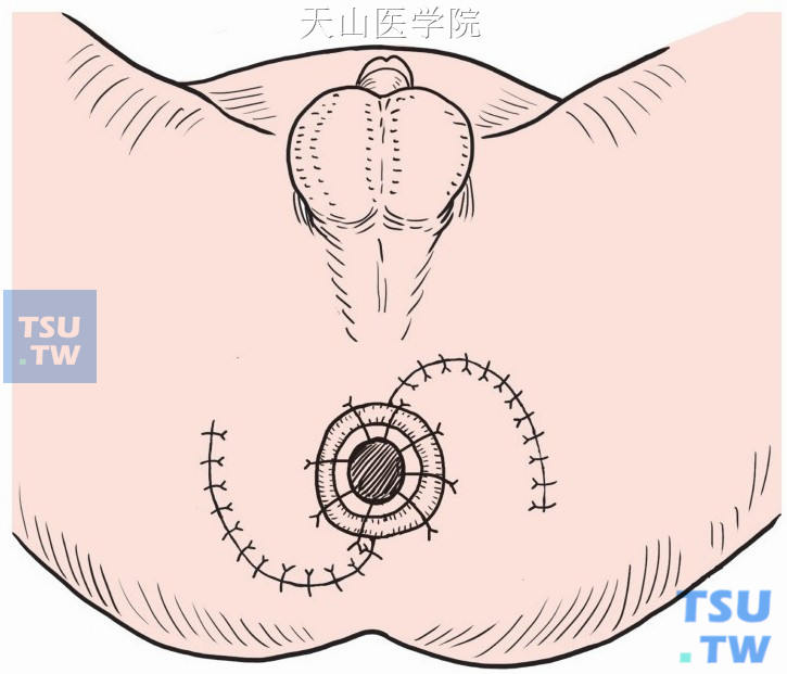 两侧皮片移植在肛管两侧，等分将皮片与直肠粘膜缝合
