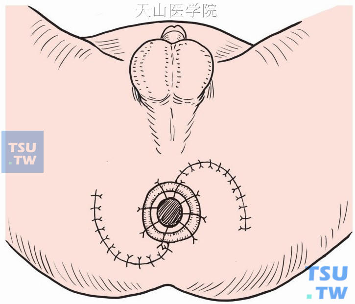 男性肛门手术图片