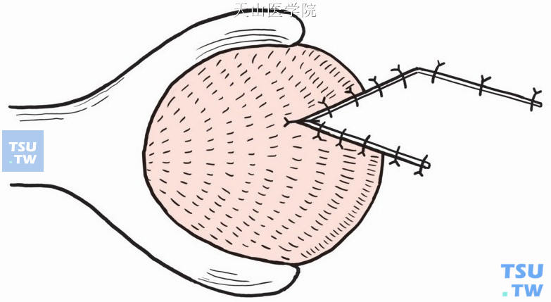 将梯形皮片牵入肛管，与粘膜间断缝合