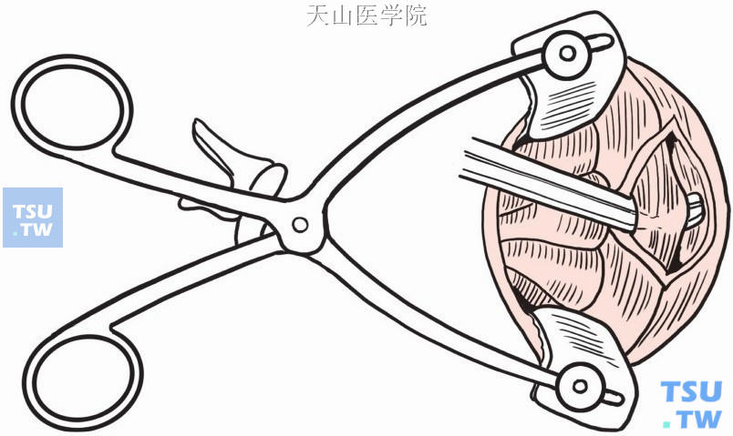 肛门内括约肌切断术