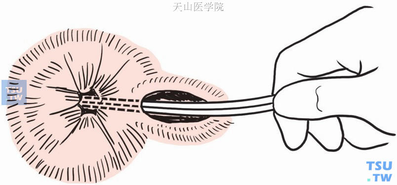 经脓肿切口插入探针