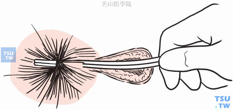 探针自外口插入内口引出