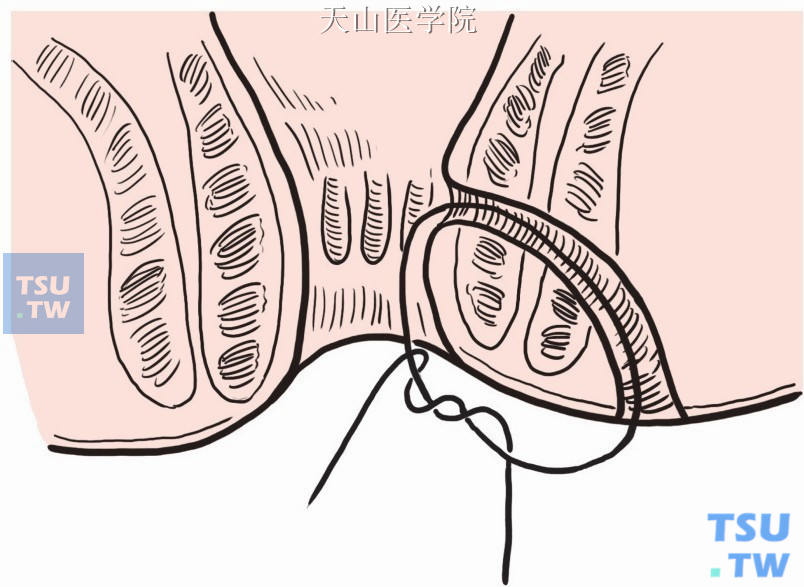 肛直肠瘘分期切开术