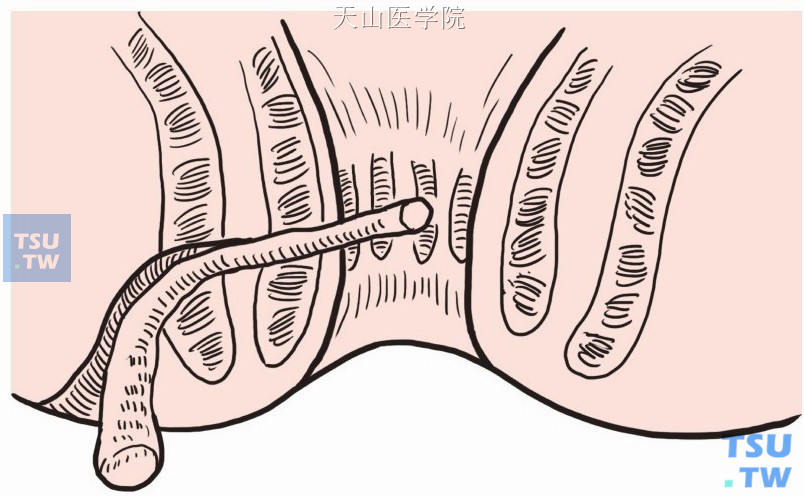 沿瘘管分离至通过外括约肌处，切除部分瘘管