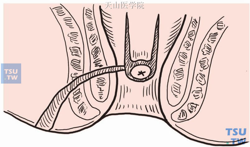 直肠粘膜瓣转移术
