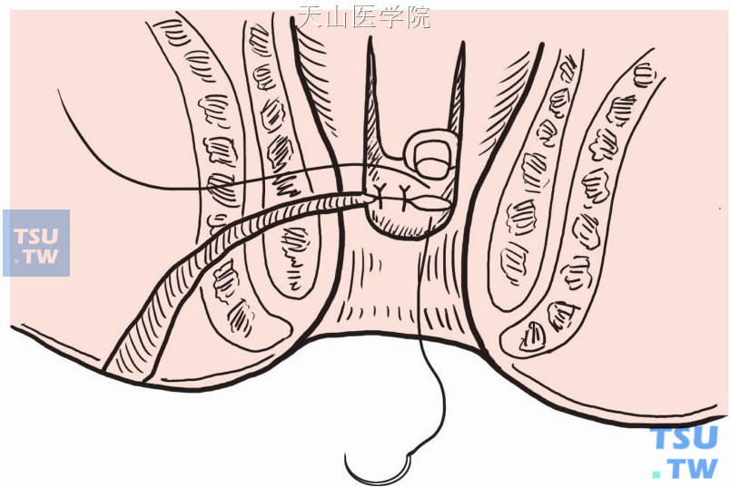 切除内口周围粘膜，显露肌层上缺口后缝合