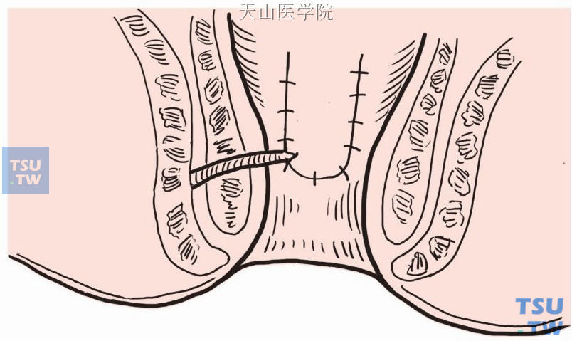 粘膜瓣与远端粘膜切缘间断缝合